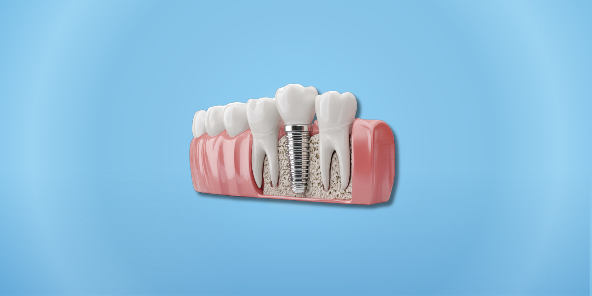 Diş Eksikliğinde İmplant Tedavisi Ertelenirse Ne Olur?