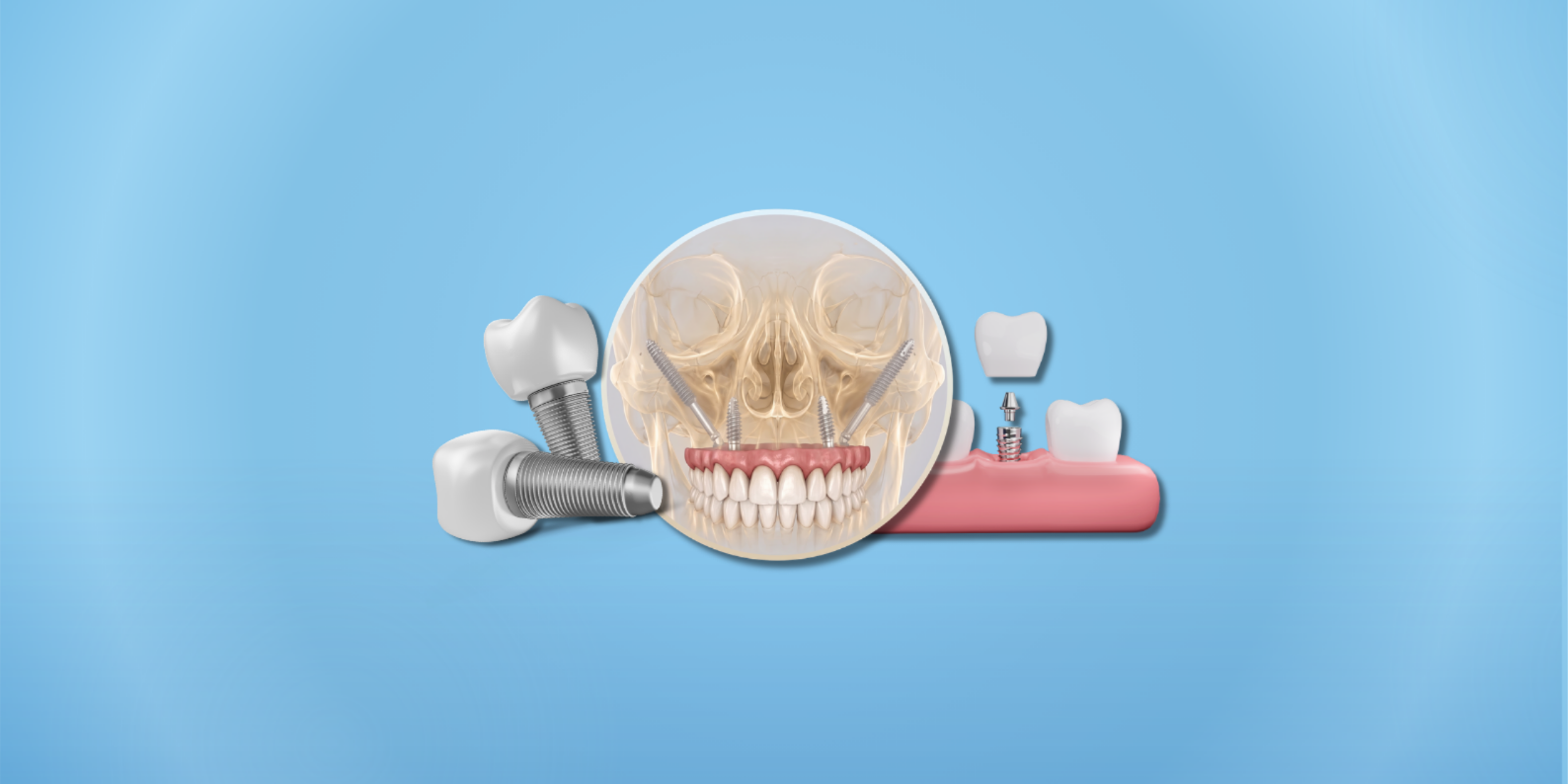 Modern Diş Hekimliğinde Dental İmplant Çeşitleri ve Klinik Uygulama Rehberi